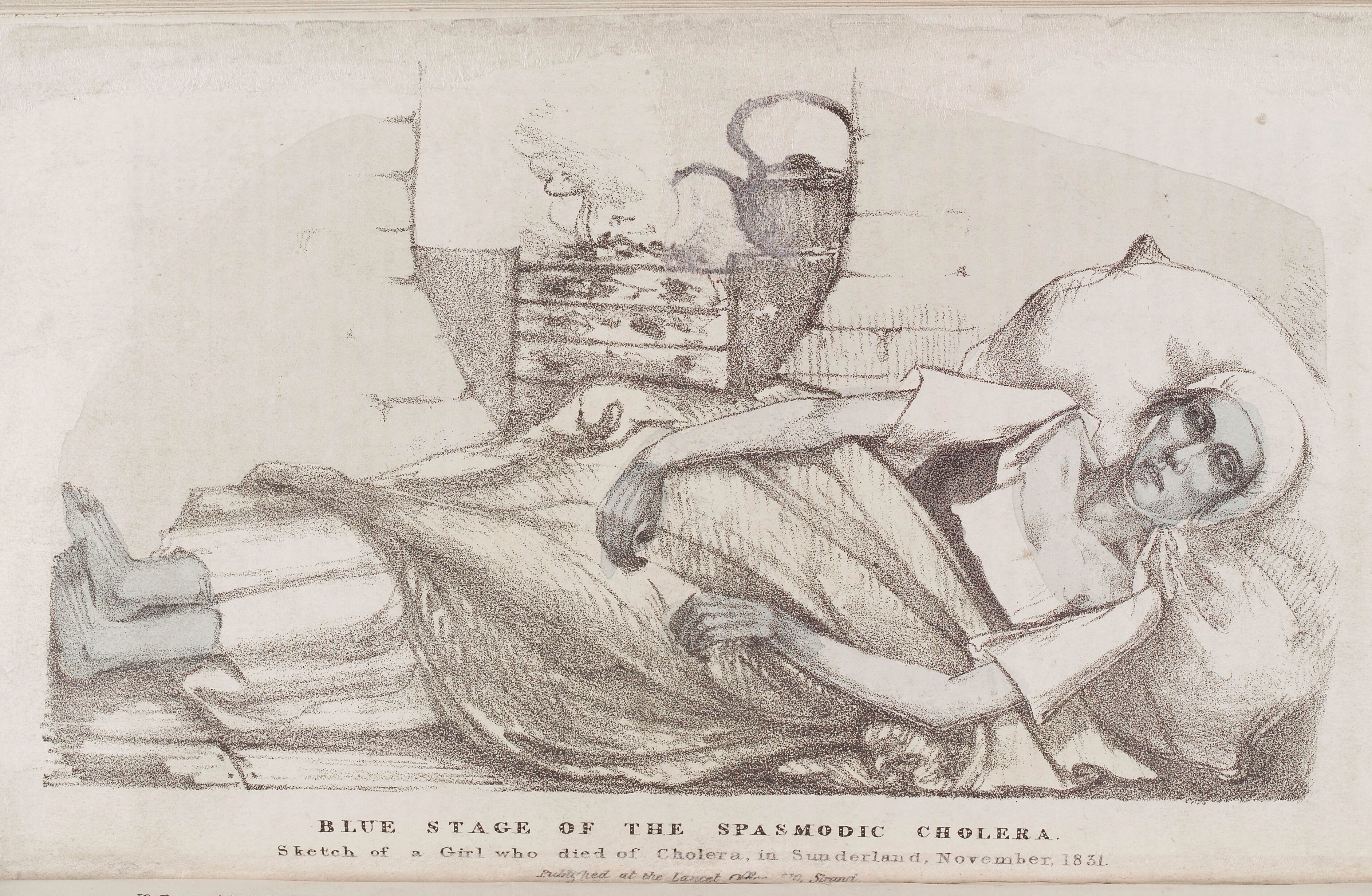 Blue stage of the spasmodic Cholera of a girls who dies in Sunderland, November 1831/welcomecollection.org