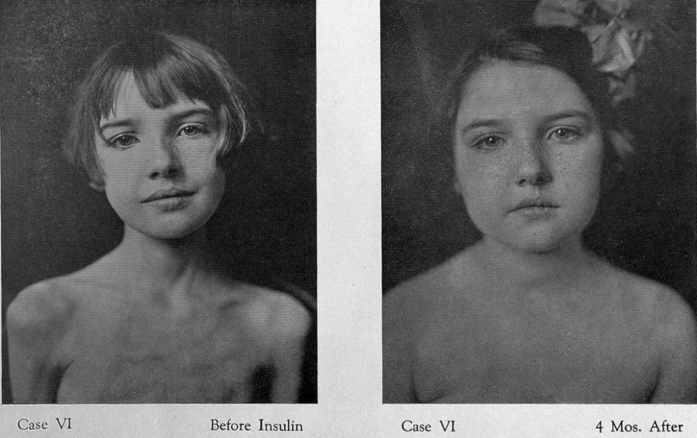 Девочка-диабетик до и после введения инсулина / Welcome Collection