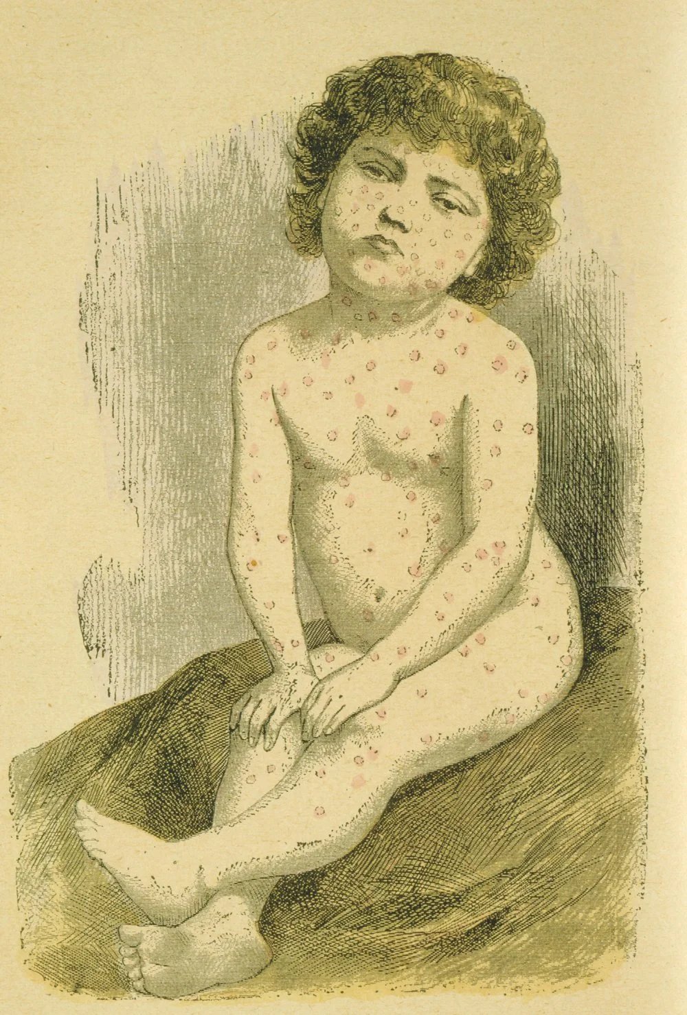 Жюль Ренгад. Ребенок, больной корью. Париж. 1890 год/Getty Images
