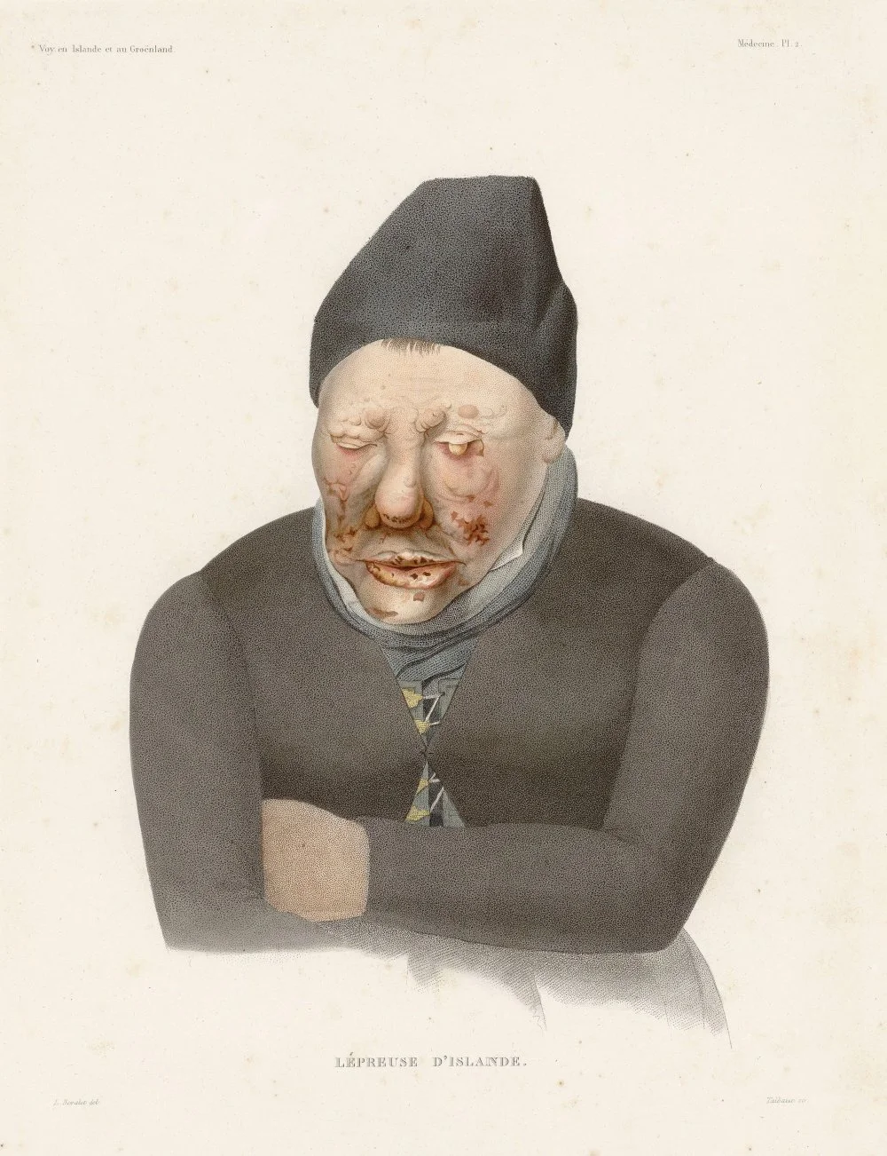 Woman with leprosy. Book "Voyage en Islande et au Groënland" by Louis-Eugène Robert. Illustrated by Antoine Maurin and published in 1835-1836/Alamy