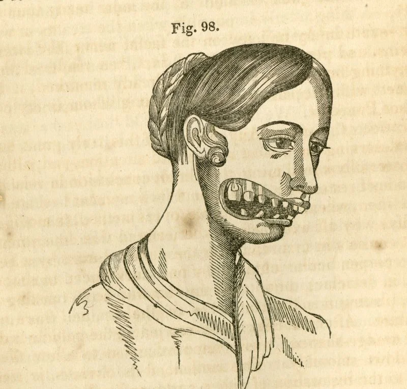 Рисунок девушки с «фосфорной челюстью» — некрозом, вызванным отравлением фосфором/Wikimedia commons