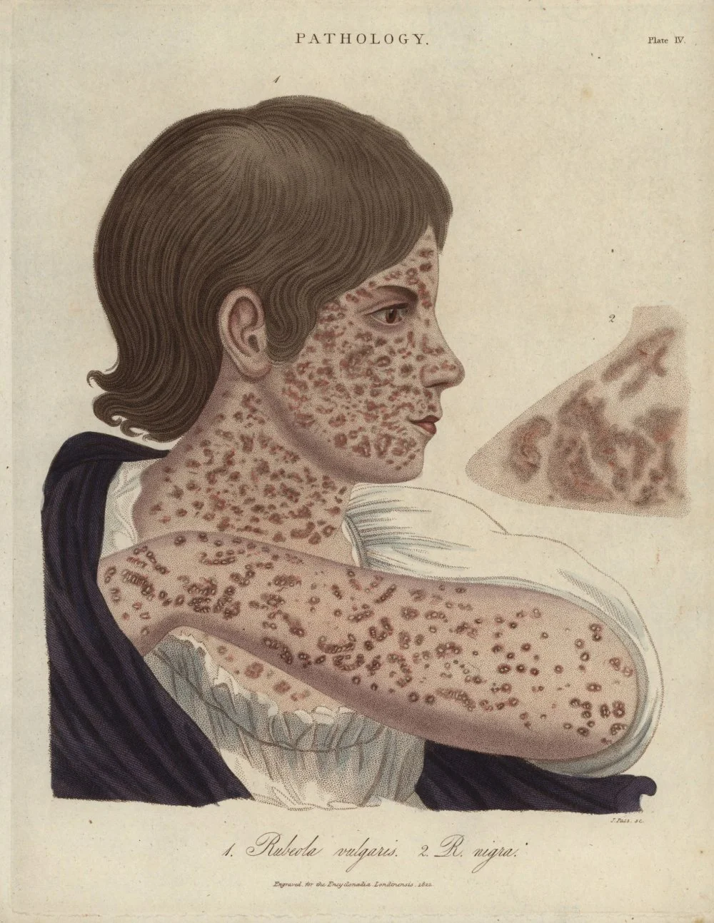 Measles, Rubeola vulgaris and R. nigra from John Wilkes' 'Encyclopedia Londinensis,' 1822/ Getty Images