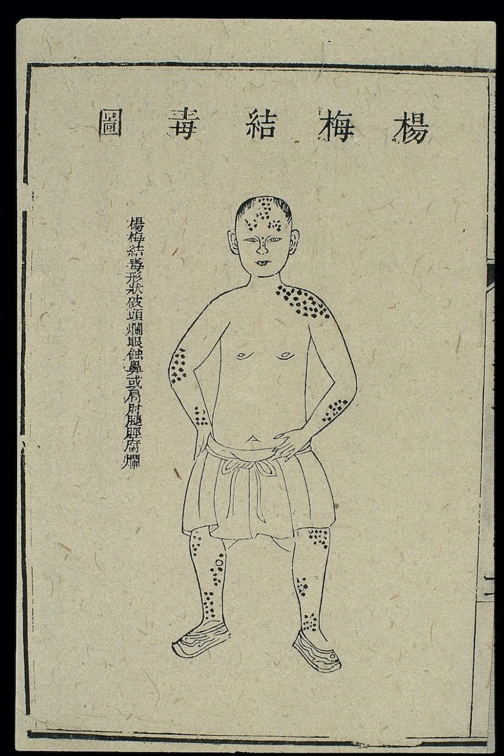 Қытайлық медициналық трактаттағы сифилистің белгілері. 18 ғасыр/Wikimedia commons